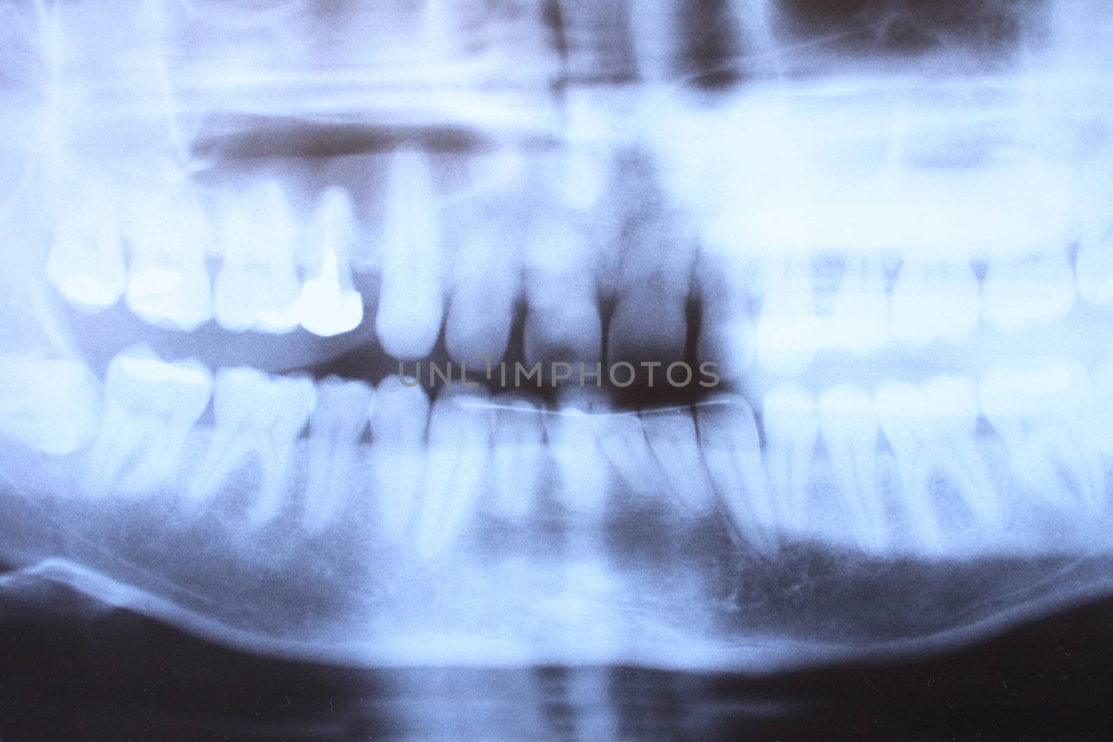 front of the teeth on the xray picture