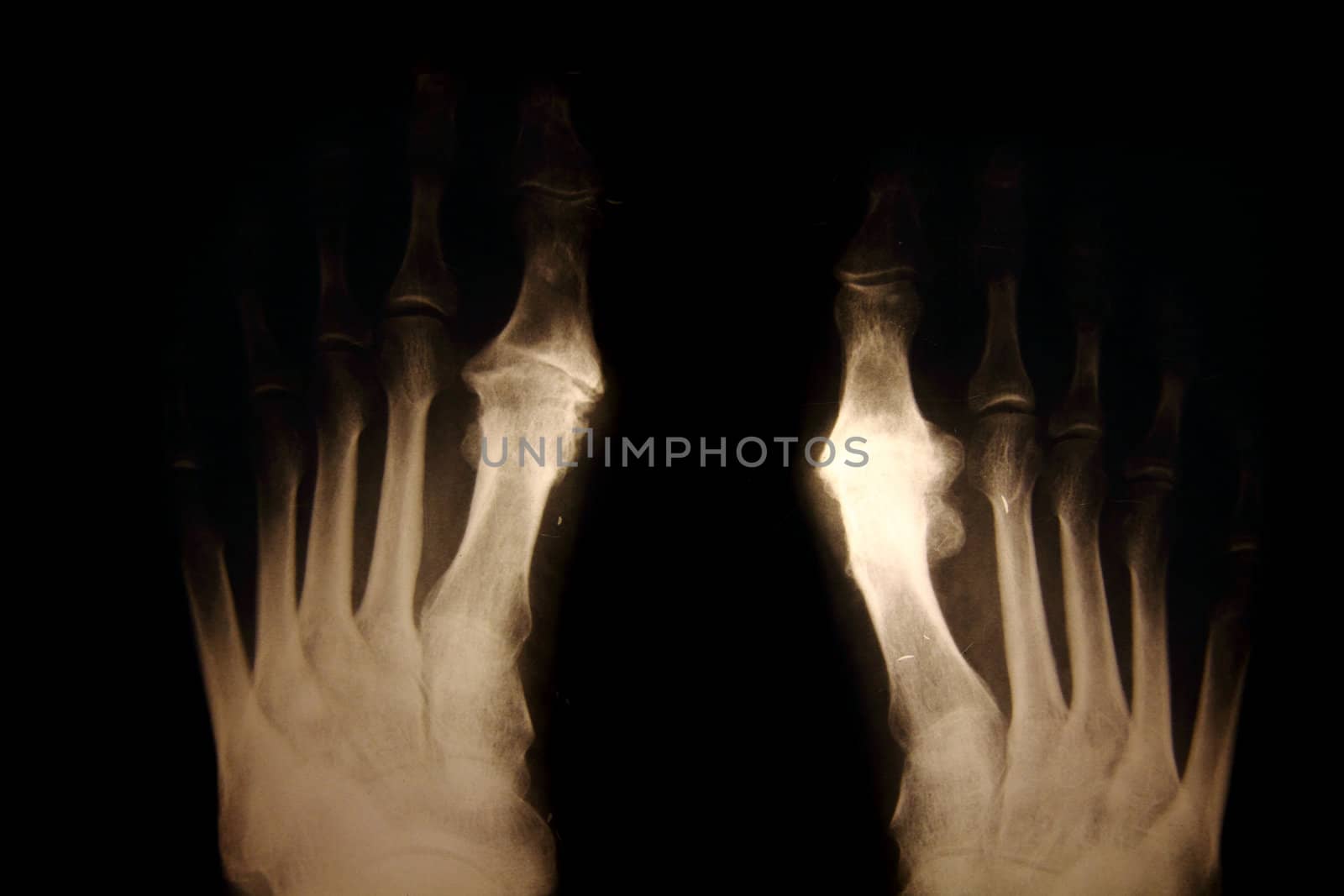 x-ray of foots as nice medical background