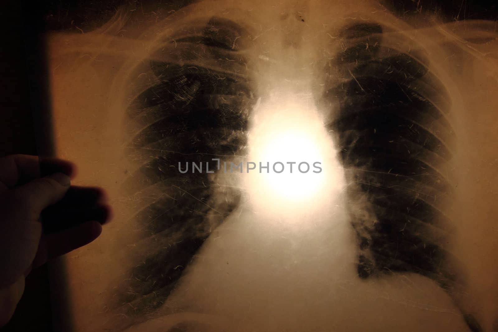 x-ray of lungs by jonnysek