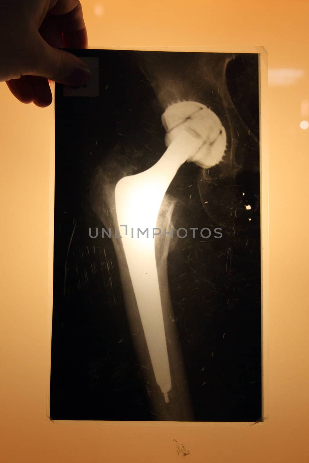 x-ray of hip endoprosthese by jonnysek