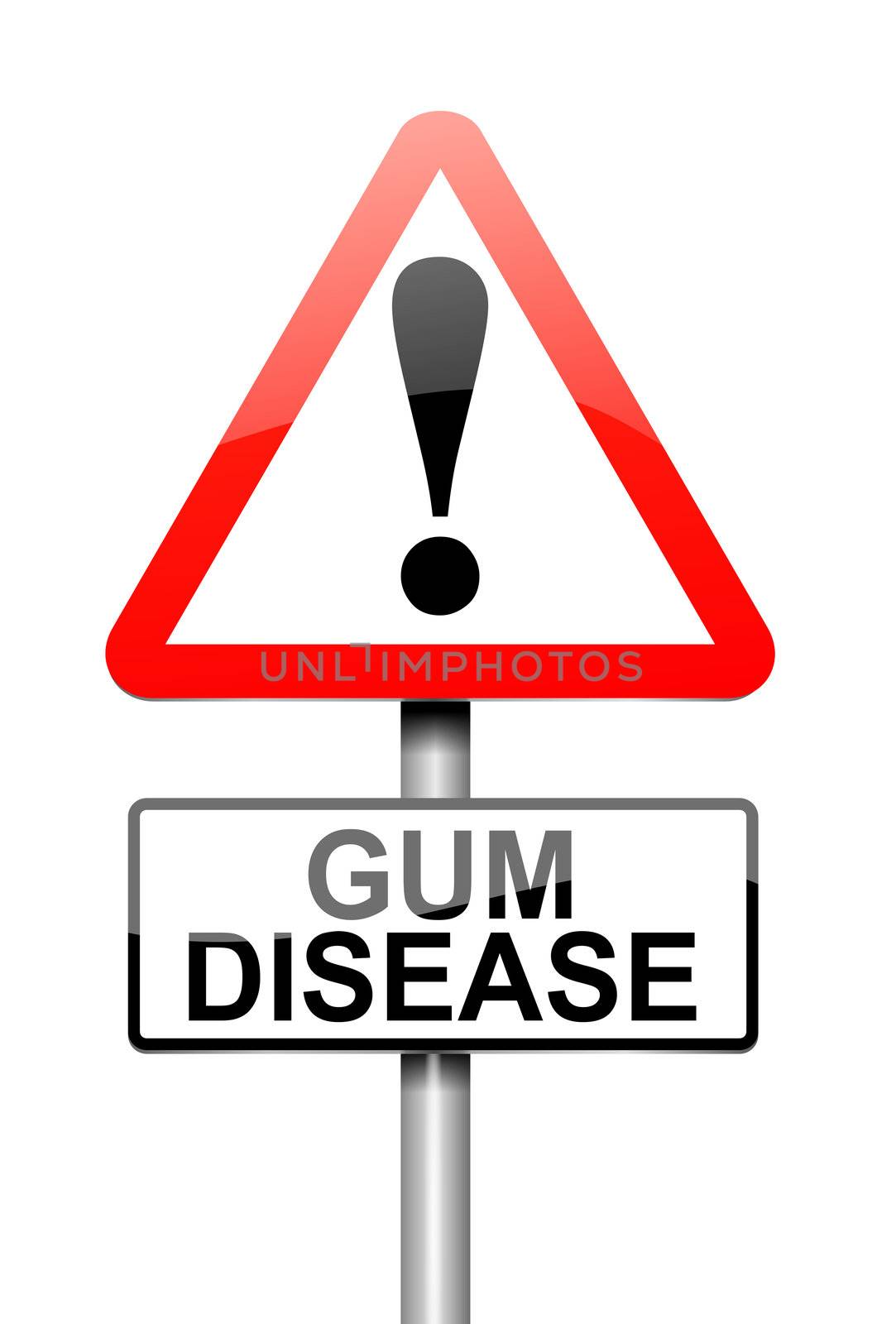 Illustration depicting a sign with a Gum disease concept.