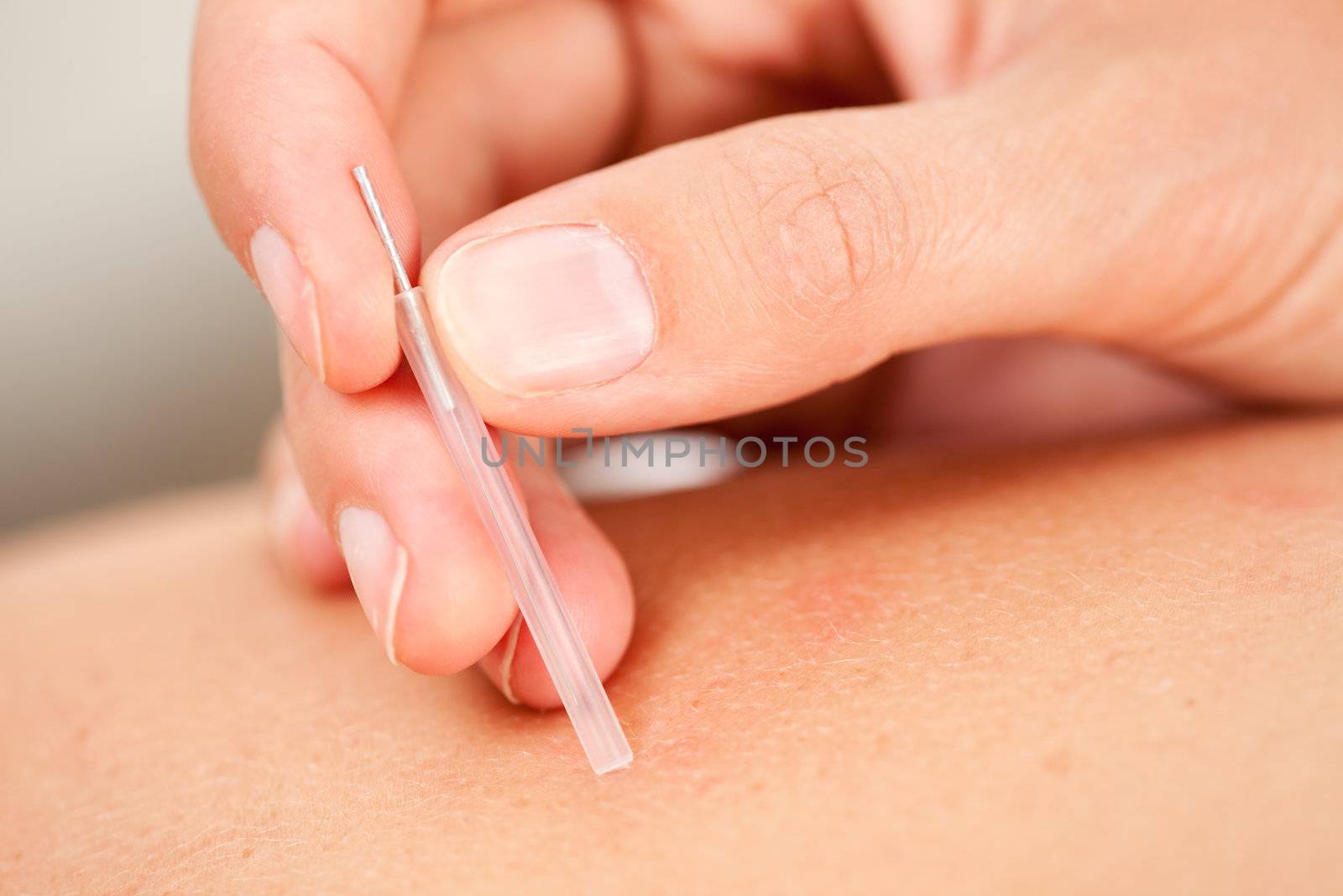 Acupuncture Needle with Insertion Tube by leaf