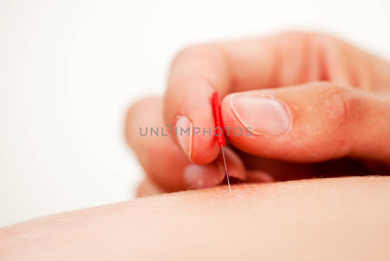 Macro detail of a acupuncture needle inserted on the back being stimulated