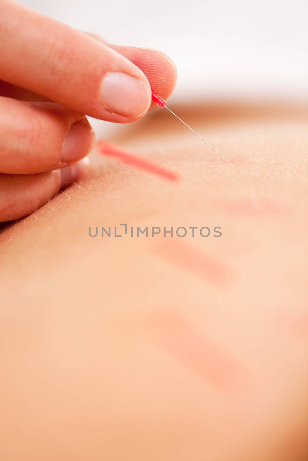 Qi - Acupuncture Neddle Rotation and Stimulation by leaf