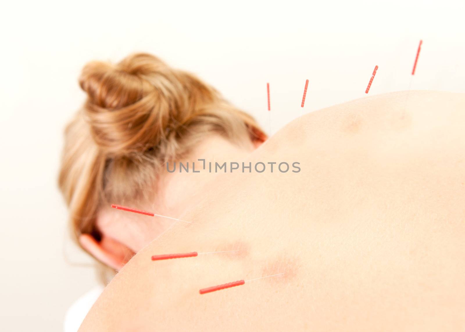 Female acupuncture patient showing good redness at the needle points, a sign of good response to the treatment