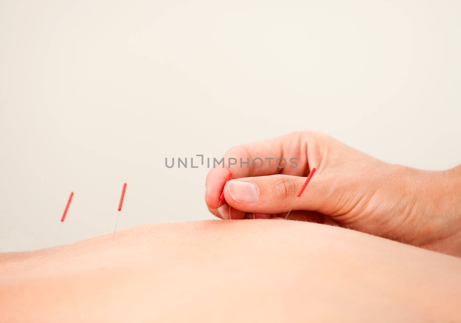 Macro detail of a hand stimulating acupuncture needles along the back