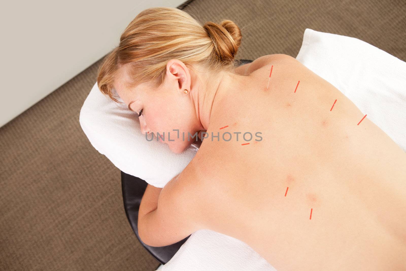 Female Patient with Acupuncture Needles in Back by leaf