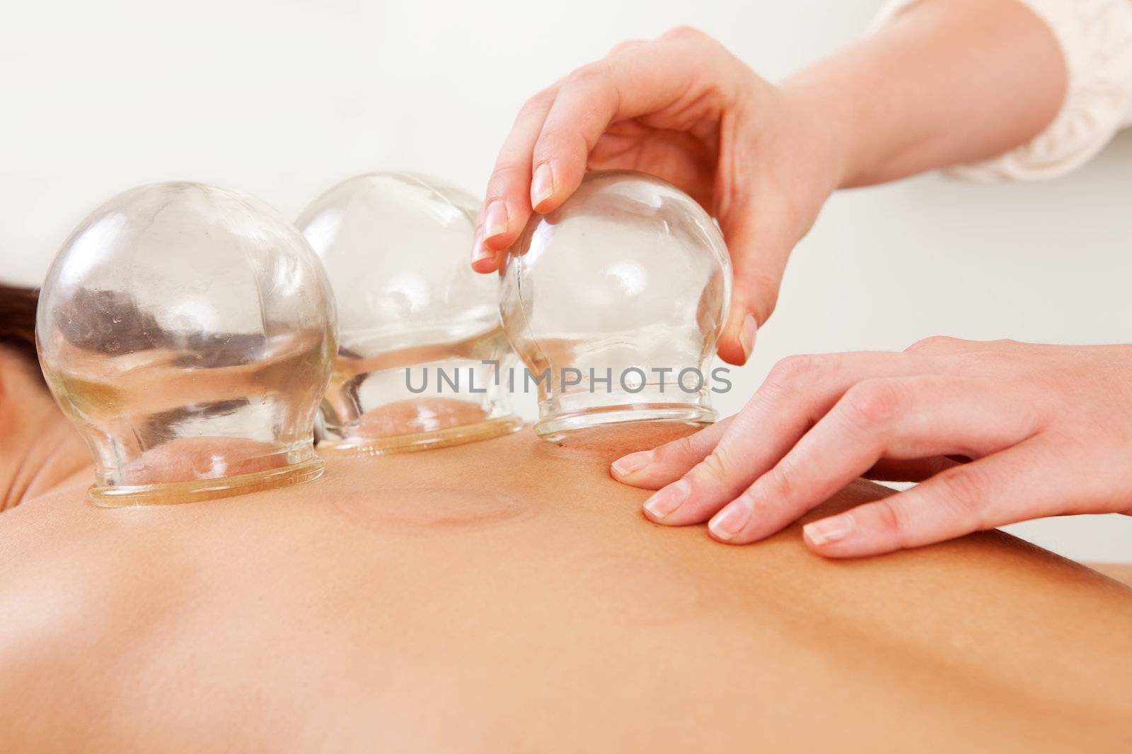 Detail of an acupuncture therapist removing a glass globe in a fire cupping procedure