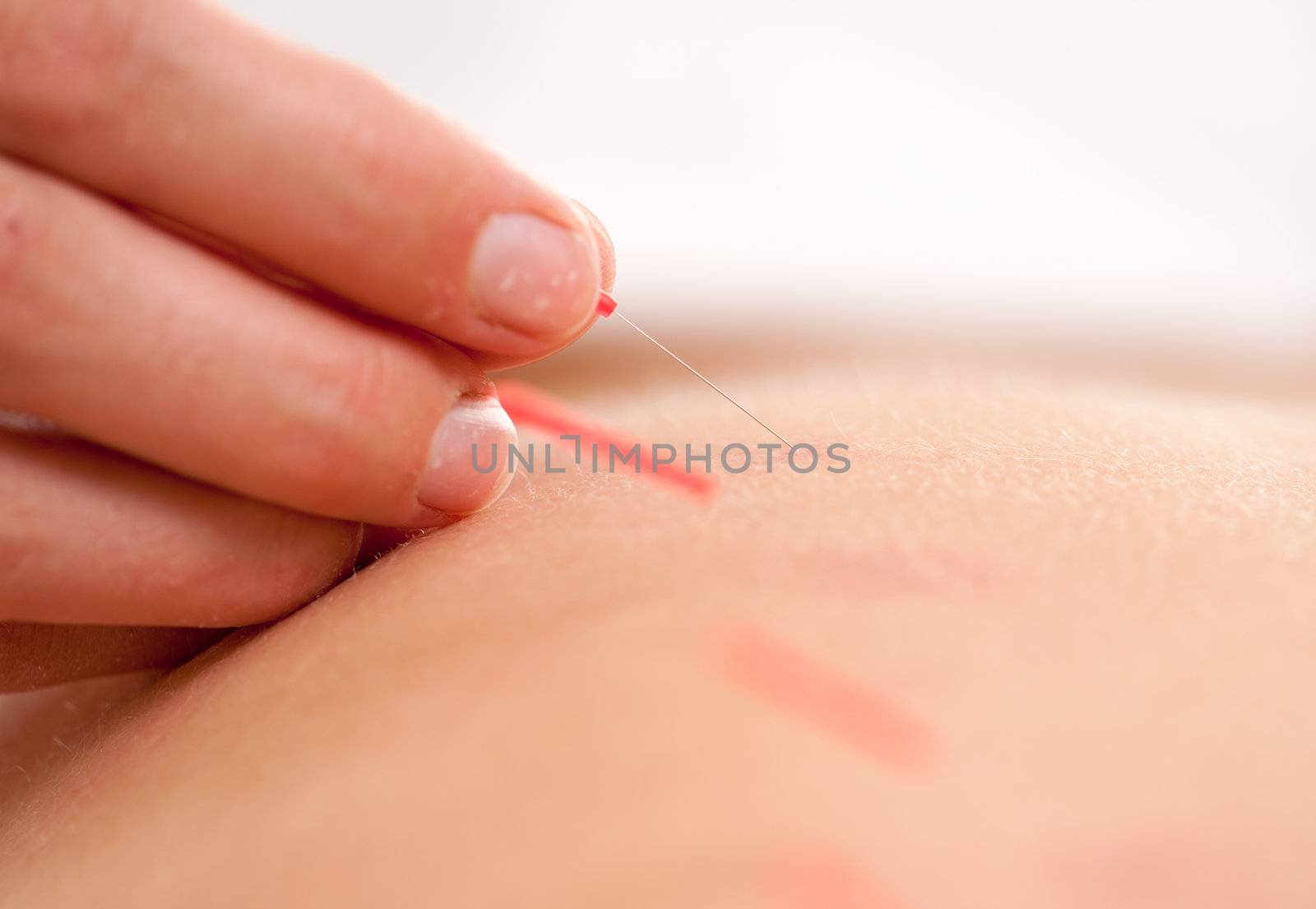 Macro detail of a hand stimulating an acupuncture needle in the back