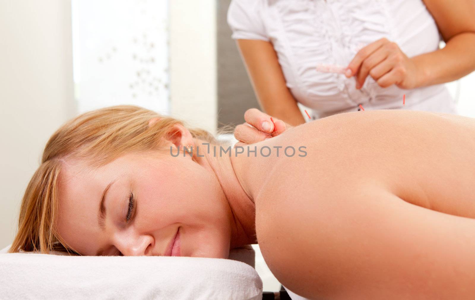 A relaxed woman receiving acupuncture on the back