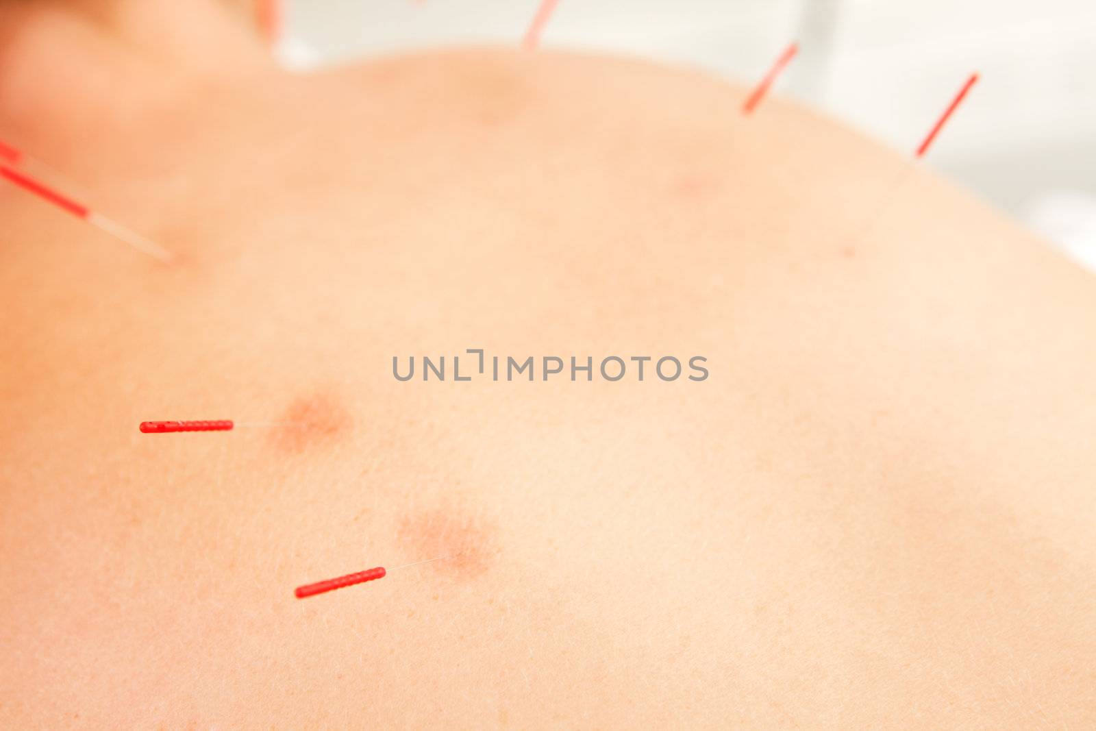 Detail of acupuncture needles inserted in the first Urinary Bladder Channel Line (Shu Points).  Redness around needles points shows good responsivness to treatment