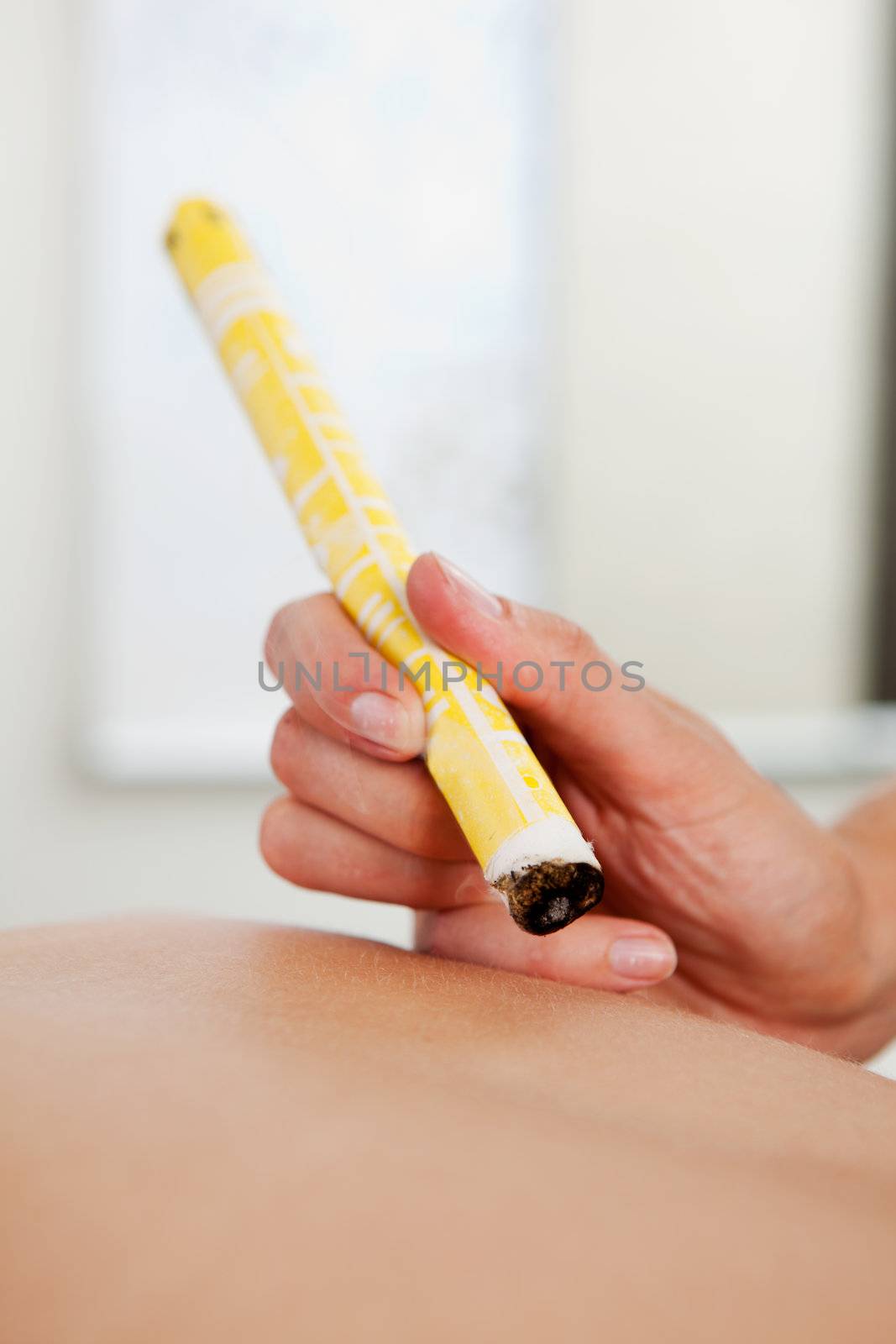 Detail of an acupuncture therapist using moxibustion on the back of a patient