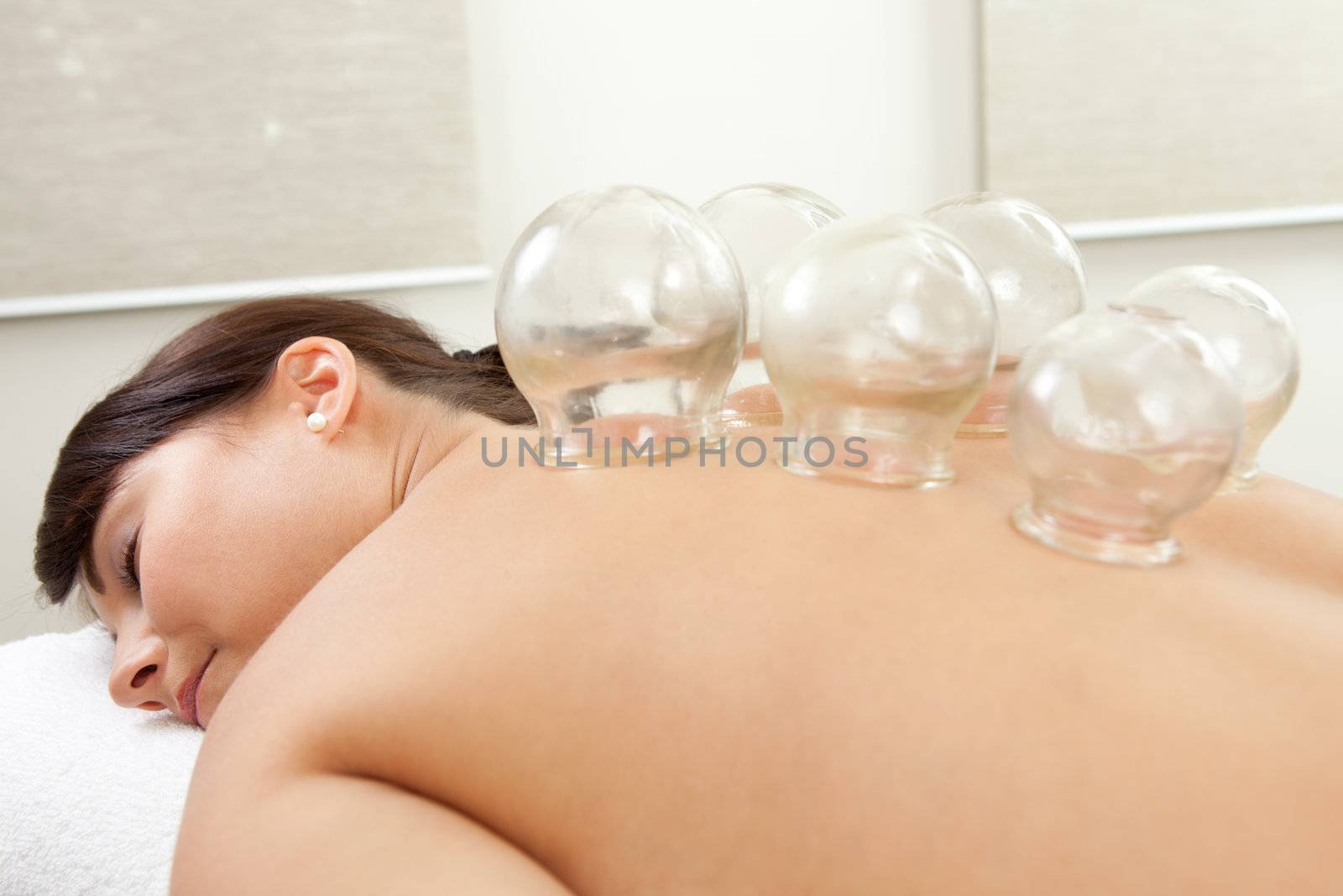 Woman with acupuncture cupping treatment on back
