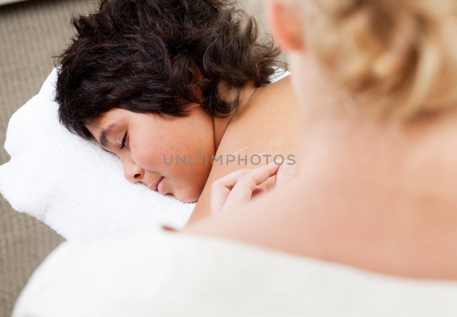 Young male with acupuncture needles in back