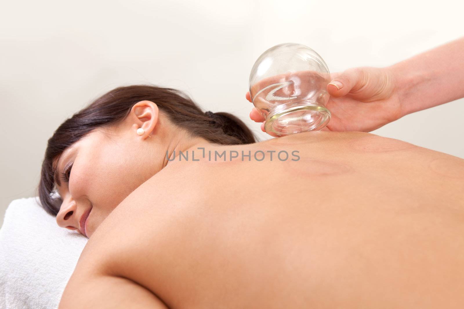 Relaxed female with back exposed after a fire cupping treatment from an acupuncture therapist