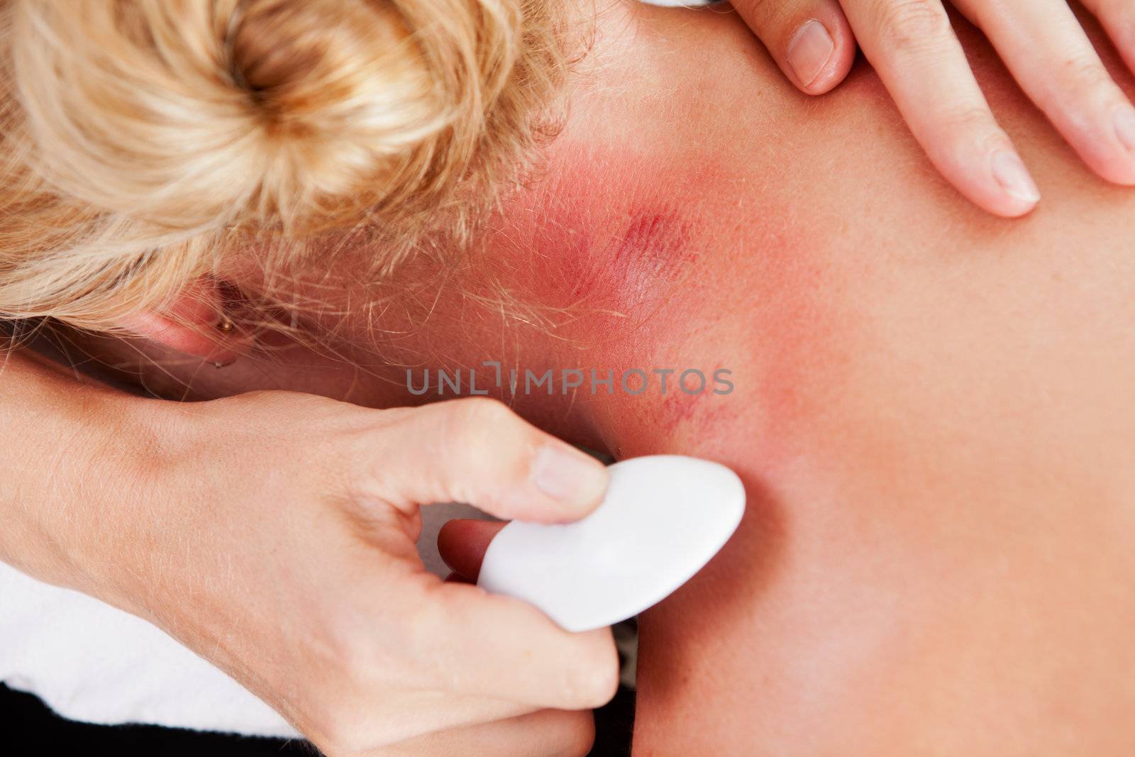 Detail of neck showing redness after gua-sha acupuncture treatment