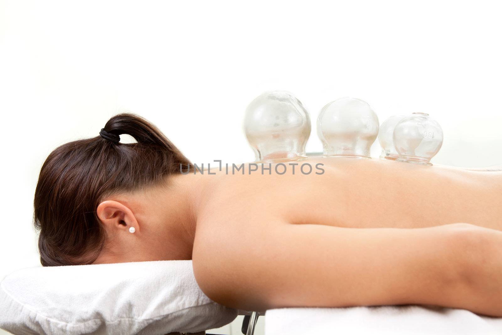 Detail of several cups placed on back of female in acupuncture cupping treatment