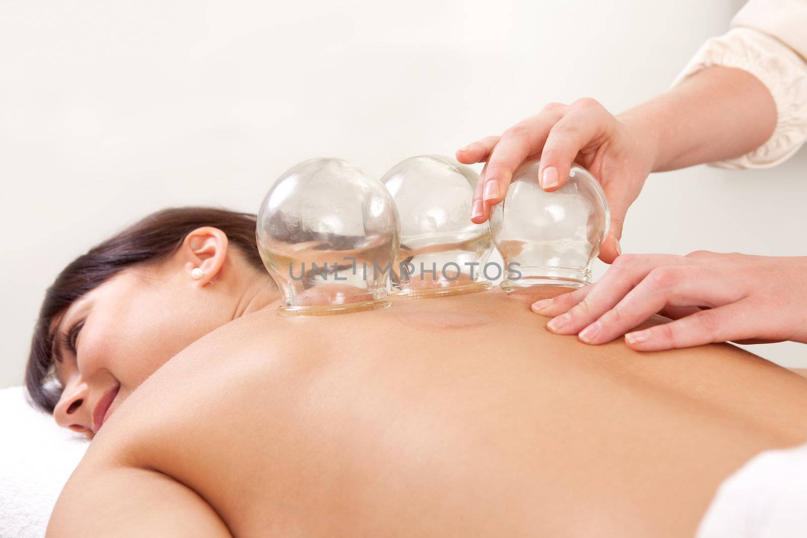 Acupuncture therapist removing a fire cupping glass from the back of a young woman