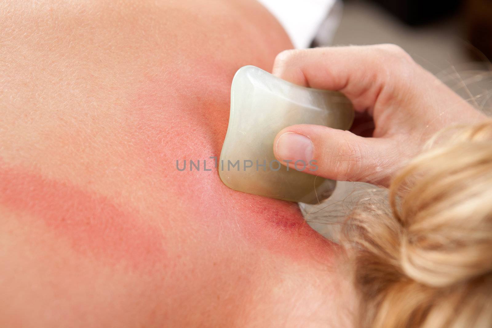 Detail showing redness on skin during a gua sha acupuncture treatment