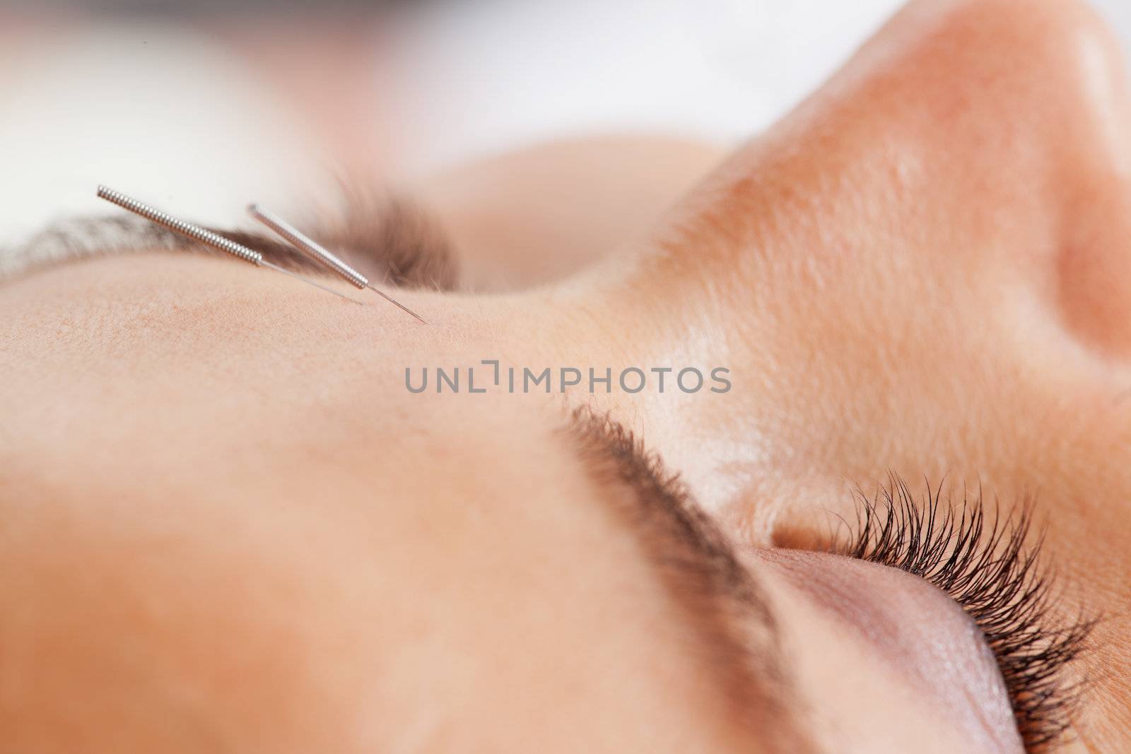 Macro detail of facial acupuncture treatment, shallow DOF focus on eye