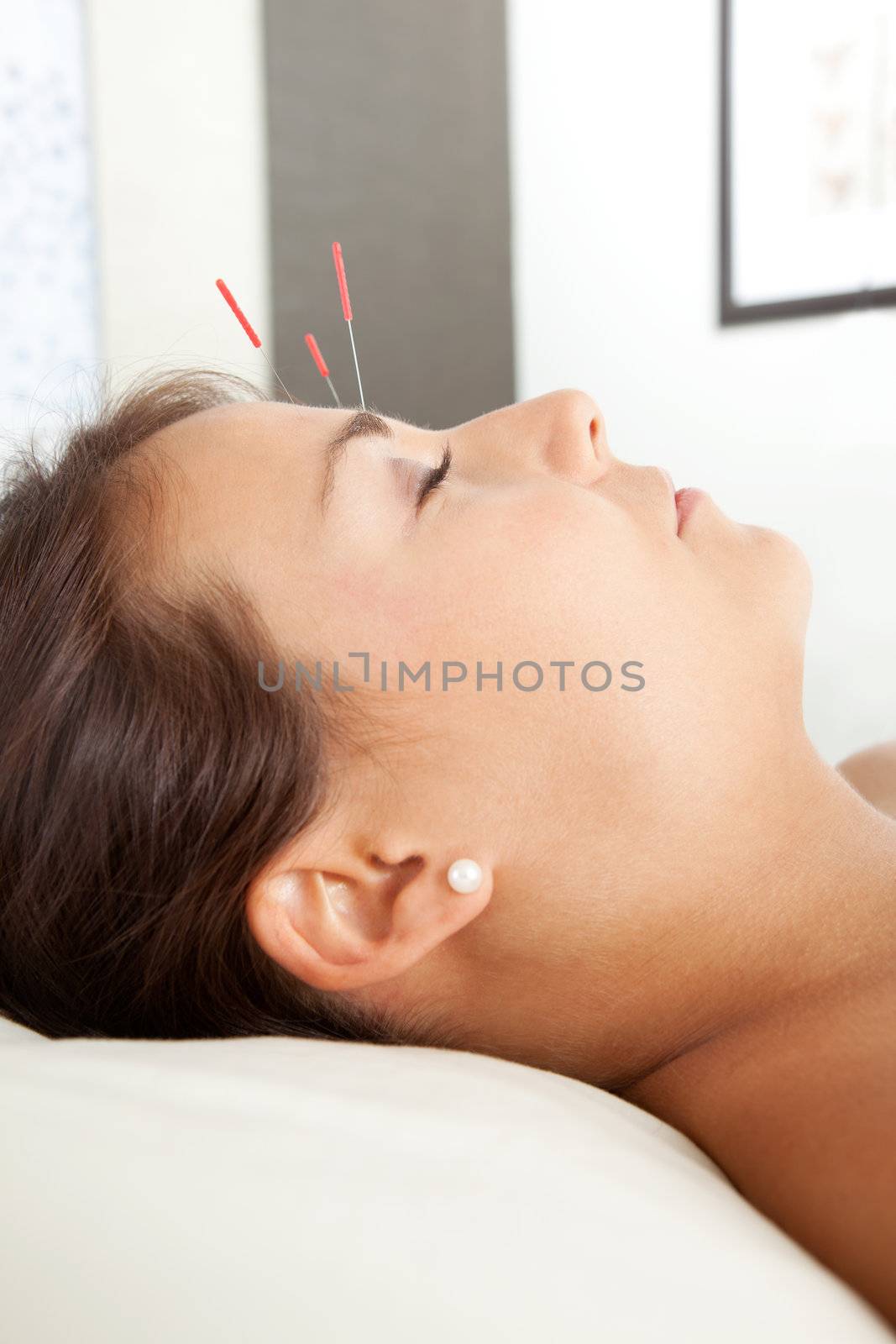 Detail of acupuncture patient with three needles in forehead