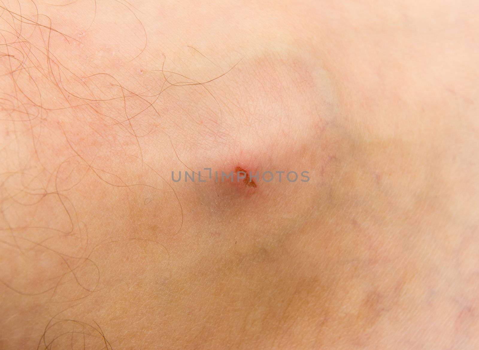 skin with a wound as the background