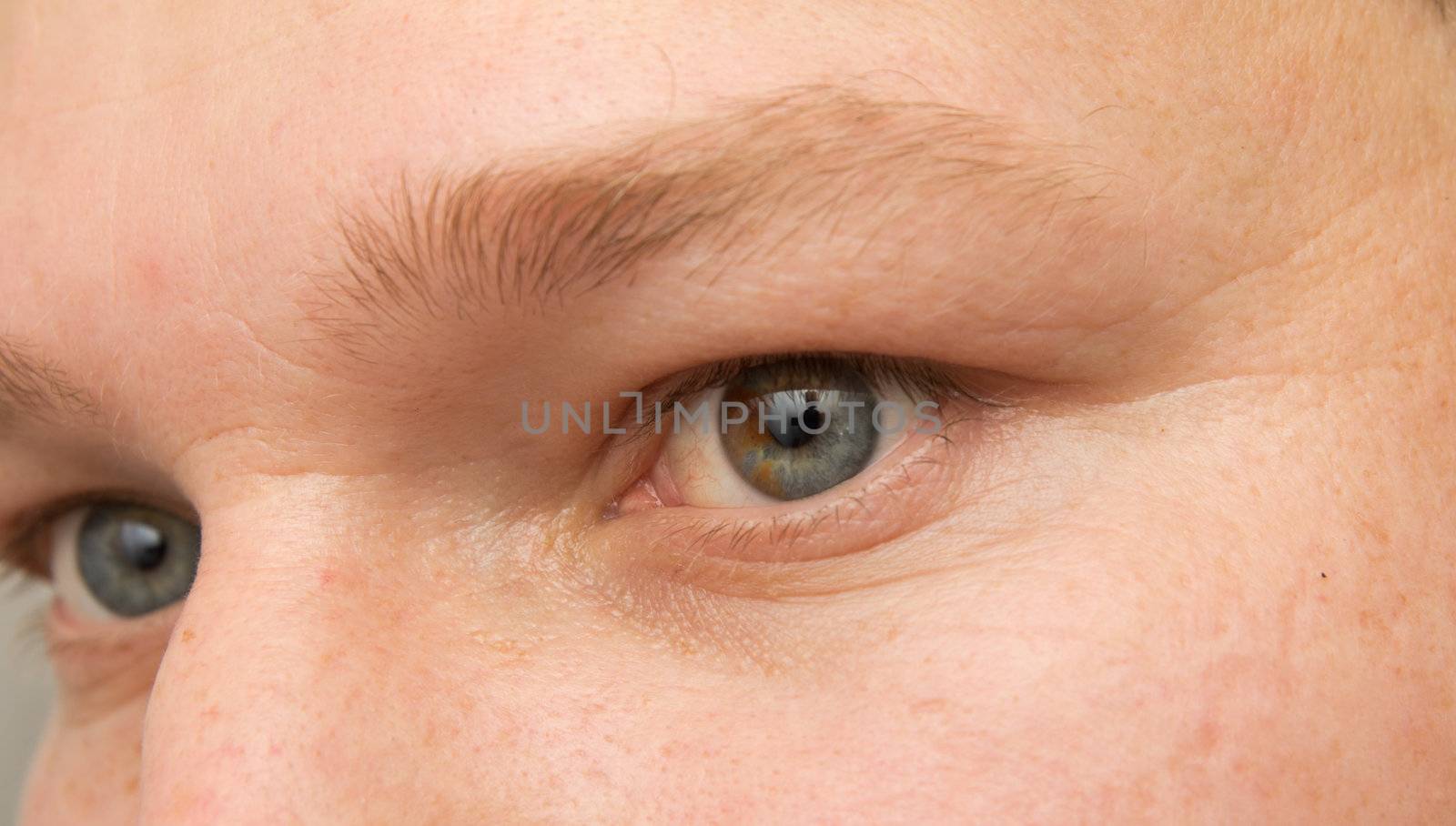 eye with a birthmark by schankz