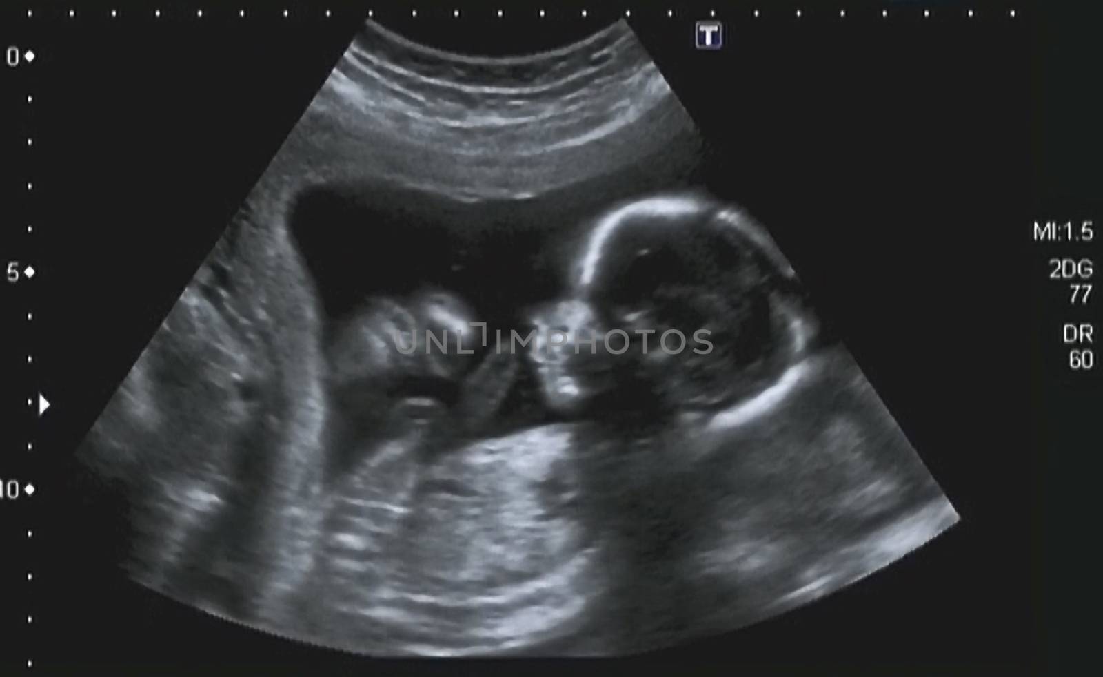 Ultrasonography Analysis of a 4th Month Fetus by jovannig