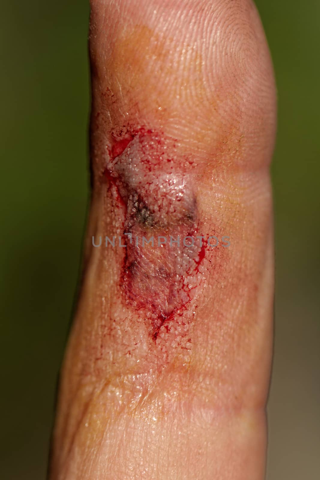 Flesh wound with blood on male finger