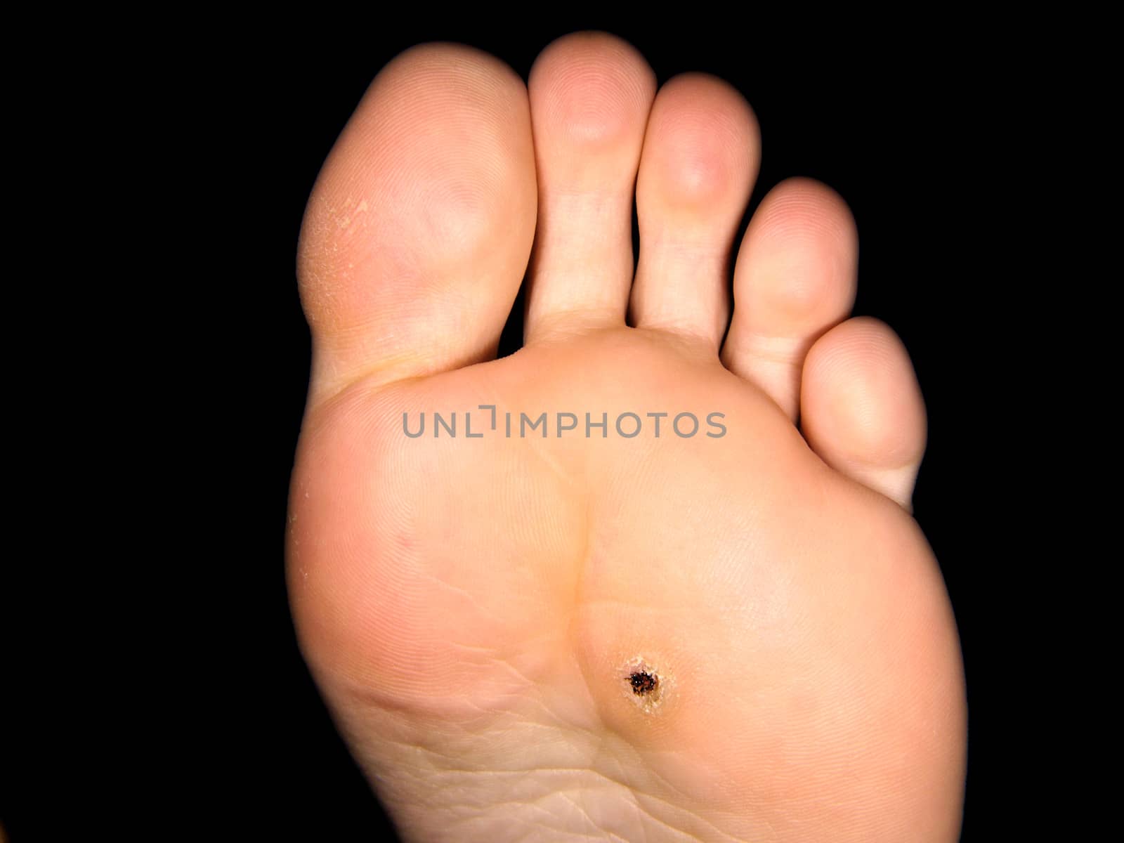 Callus under foot, isolated towards black background