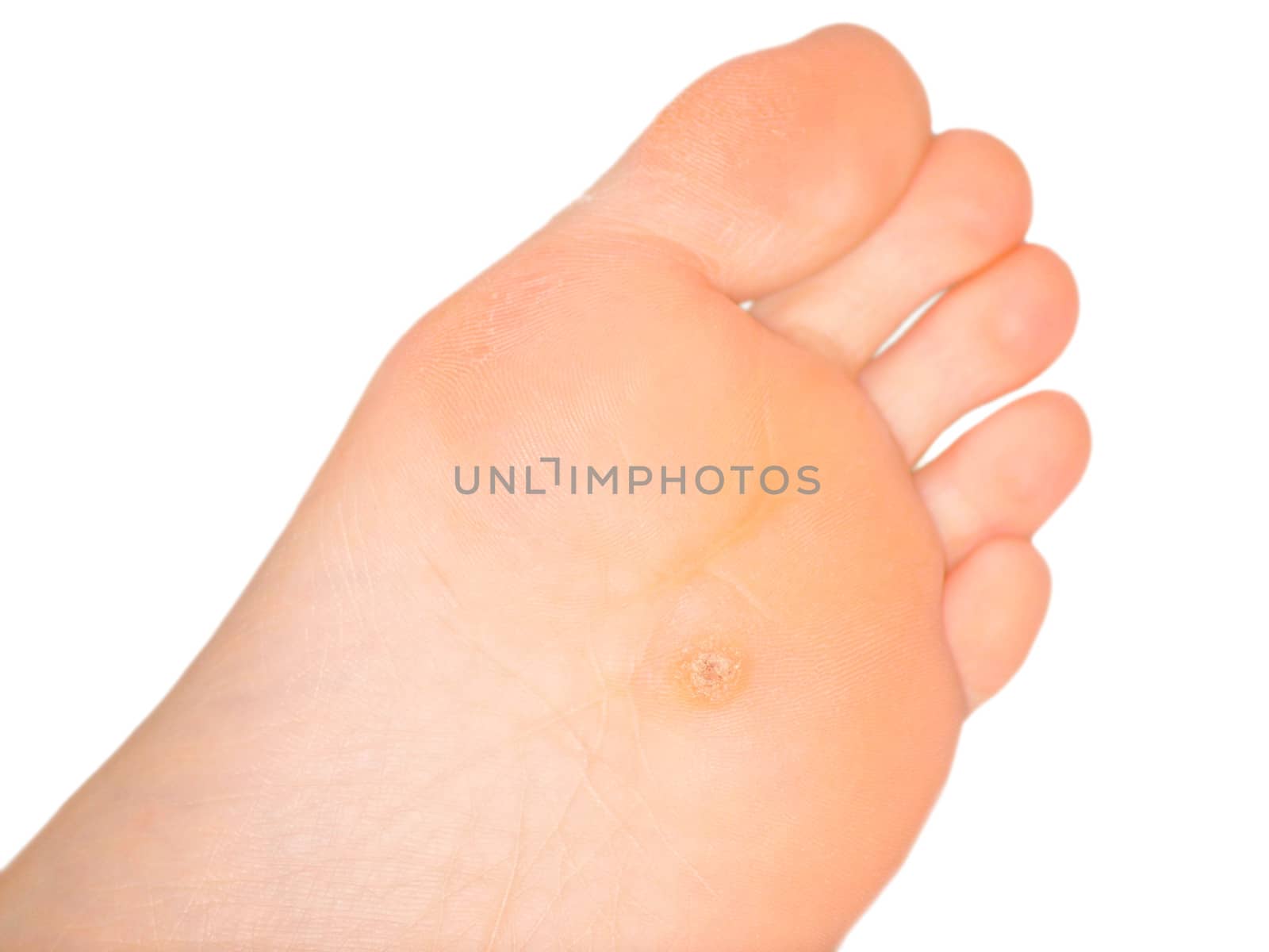 Callus under foot, center of foot, isolated towards white