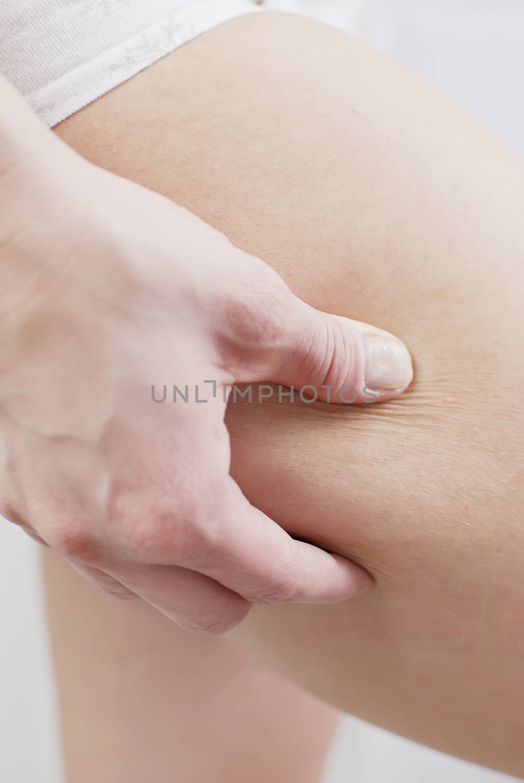 young woman holding her skin for cellulite check