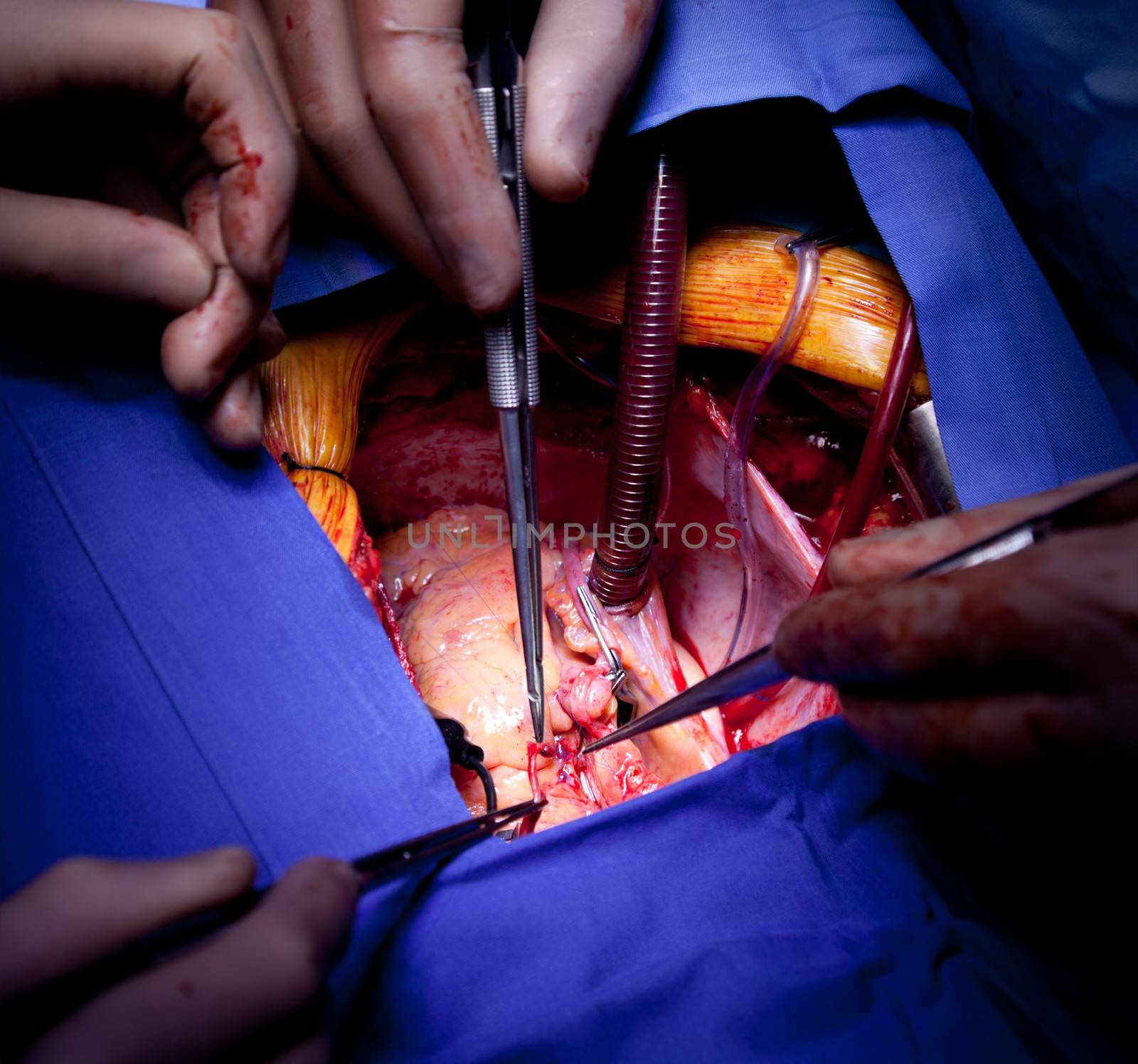 Detailed close-up of doctors hands performing cardiac surgery