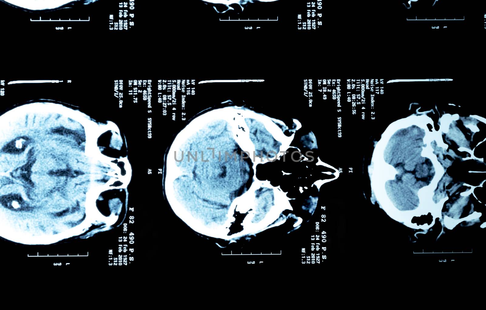 Brain x-rays of an adult person.