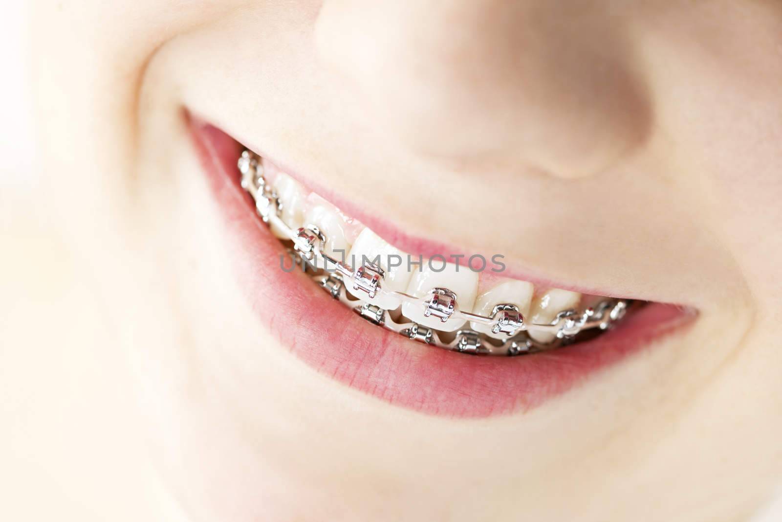 Closeup on braces and white teeth of smiling girl