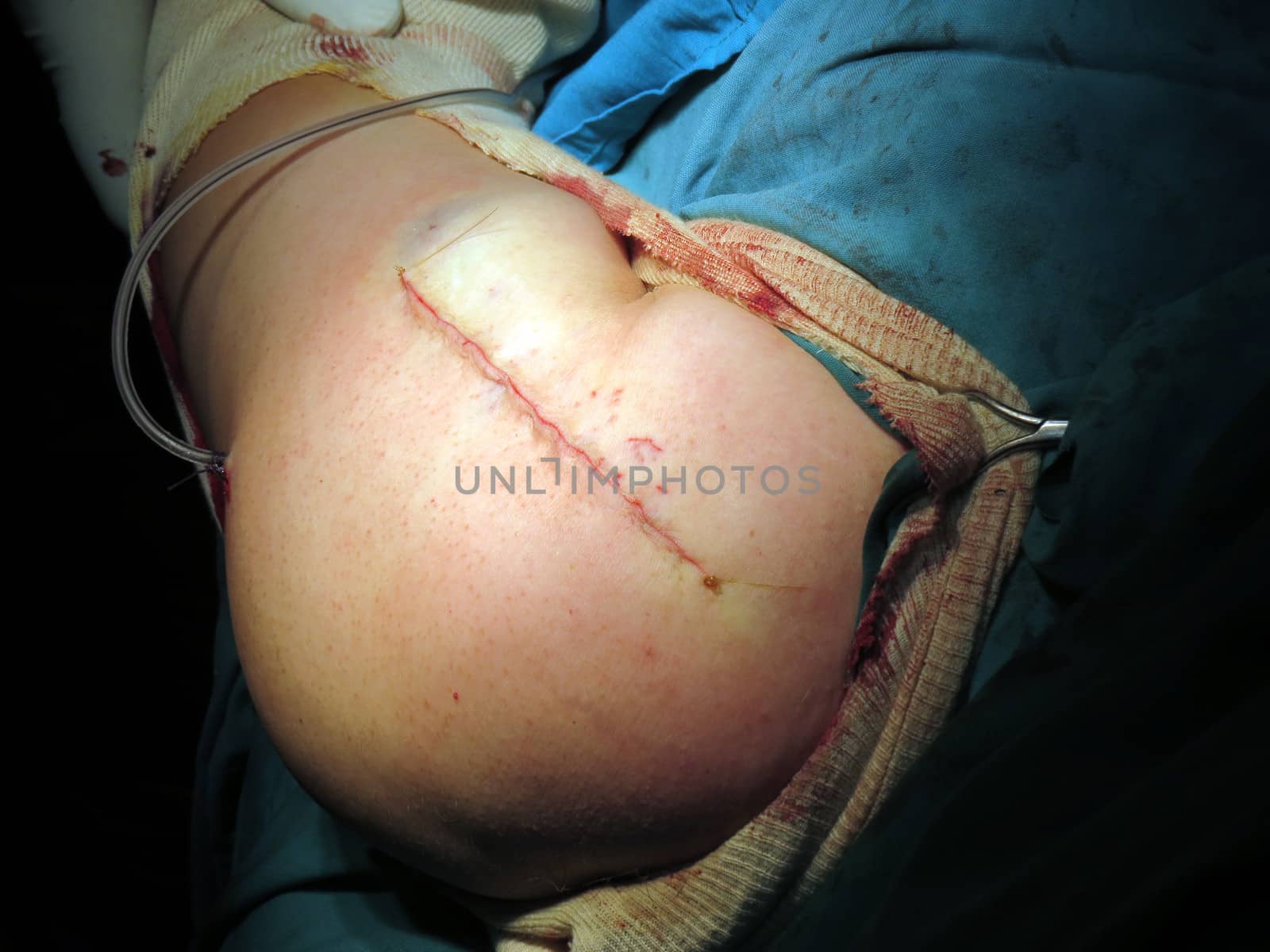 A well stitched shoulder of an accident patient after a surgery