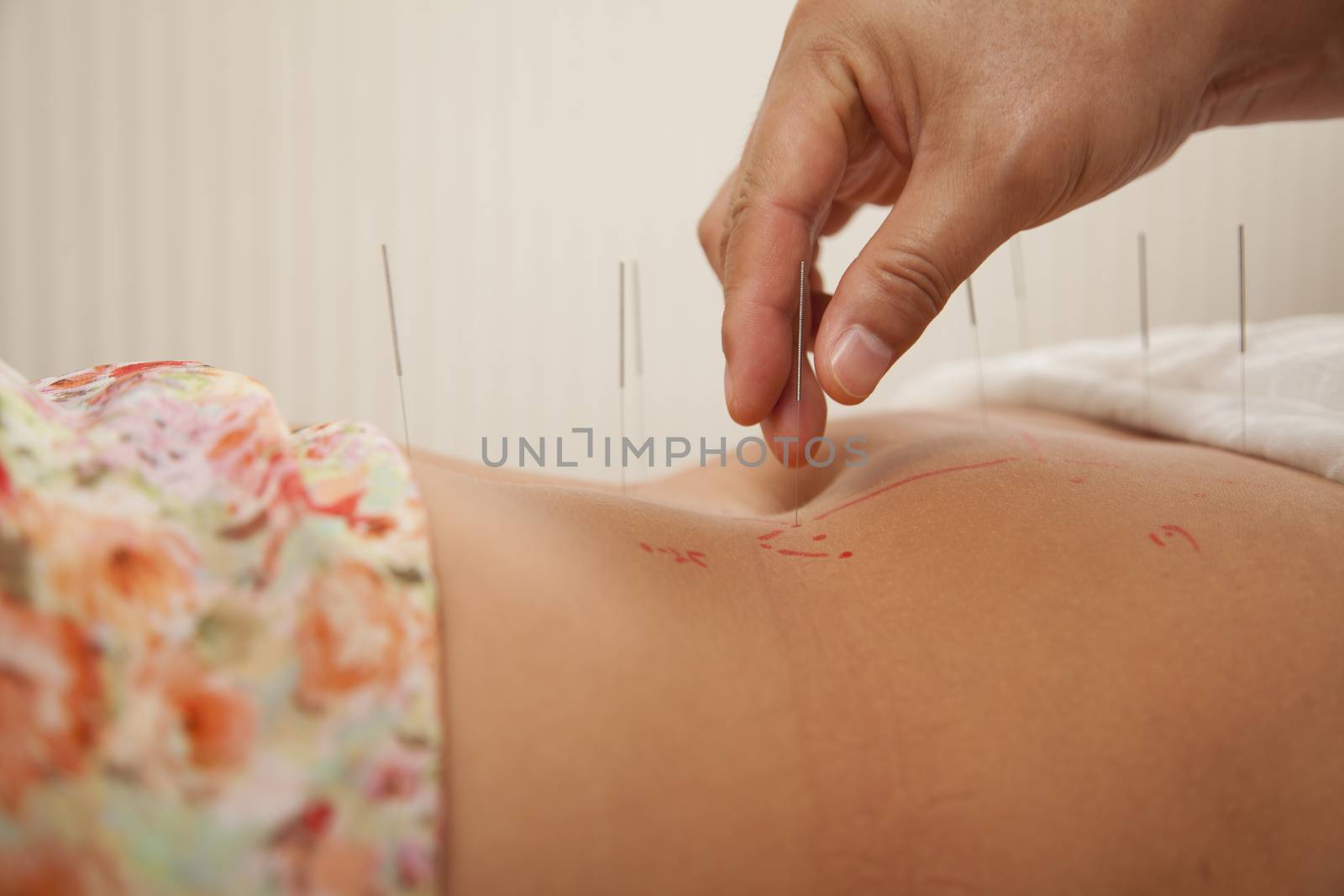 Inserting Acupuncture Needles