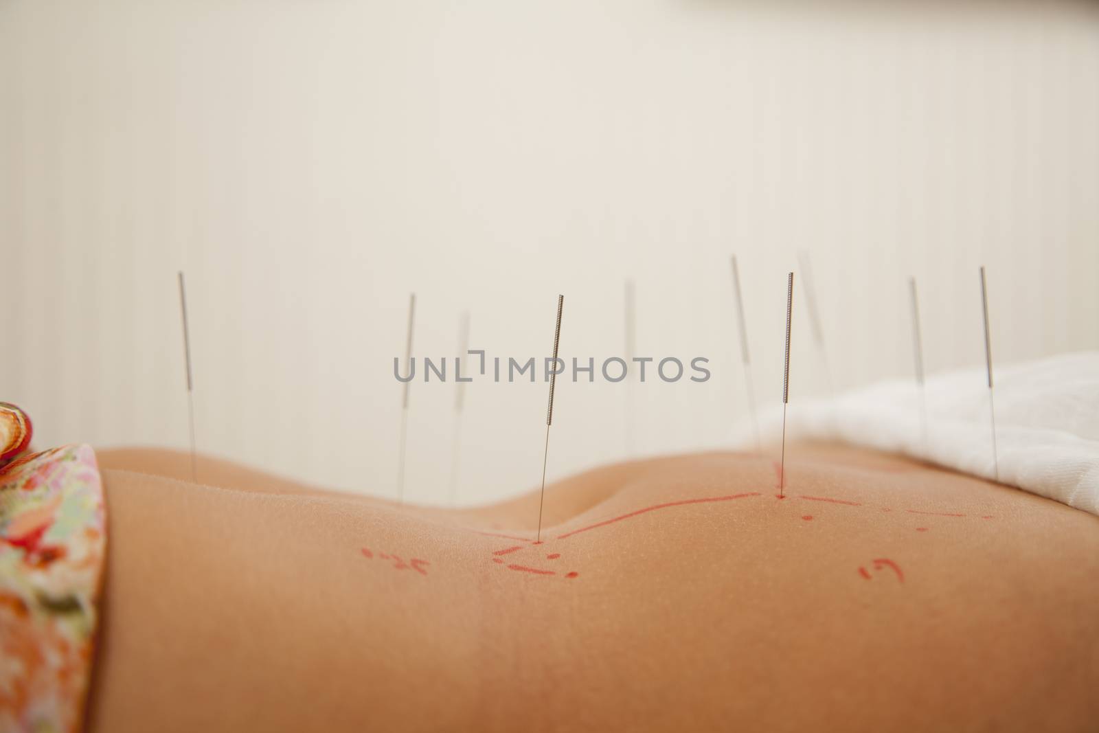 Acupuncture Needles in a Woman's Midsection