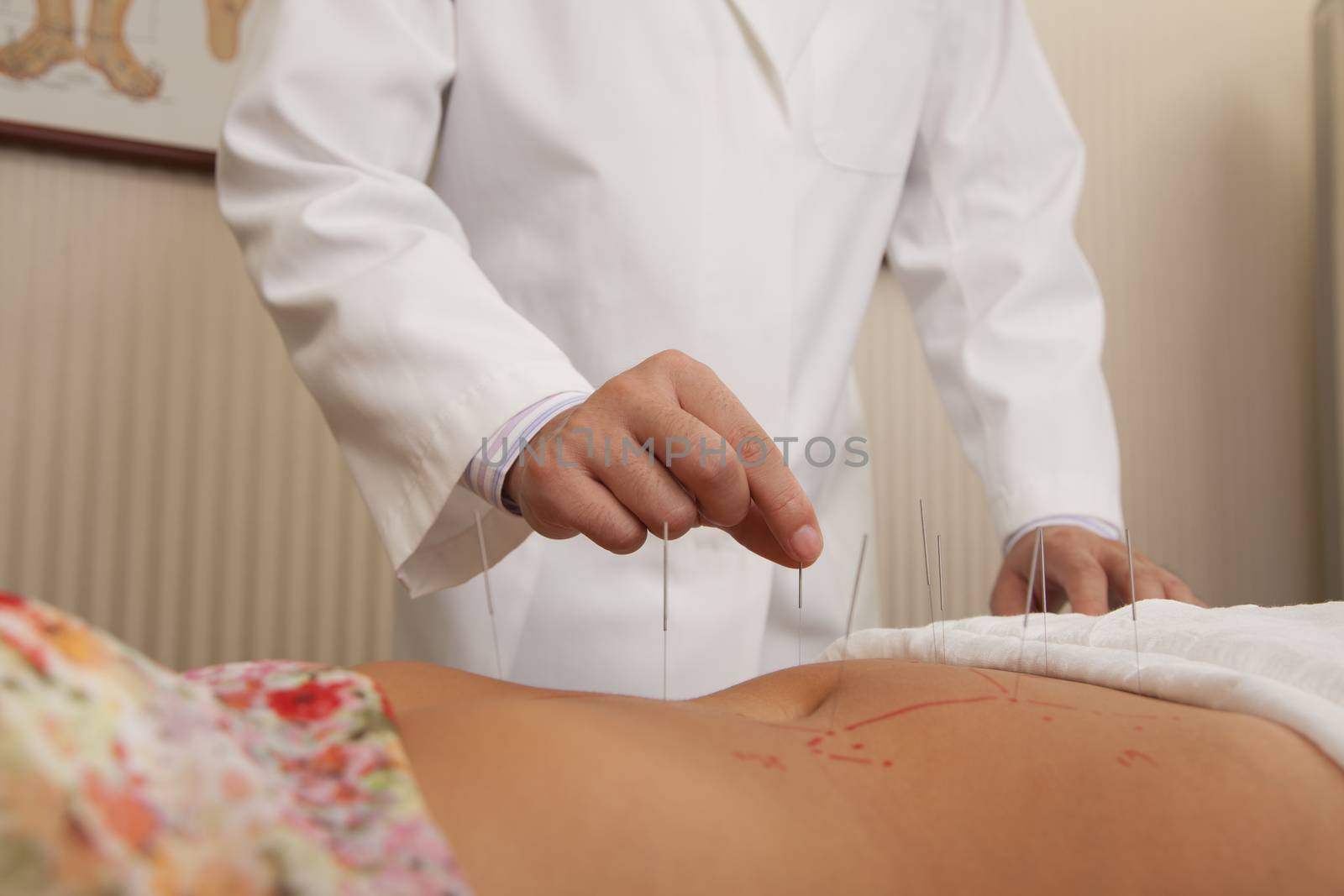 Inserting Acupuncture Needles