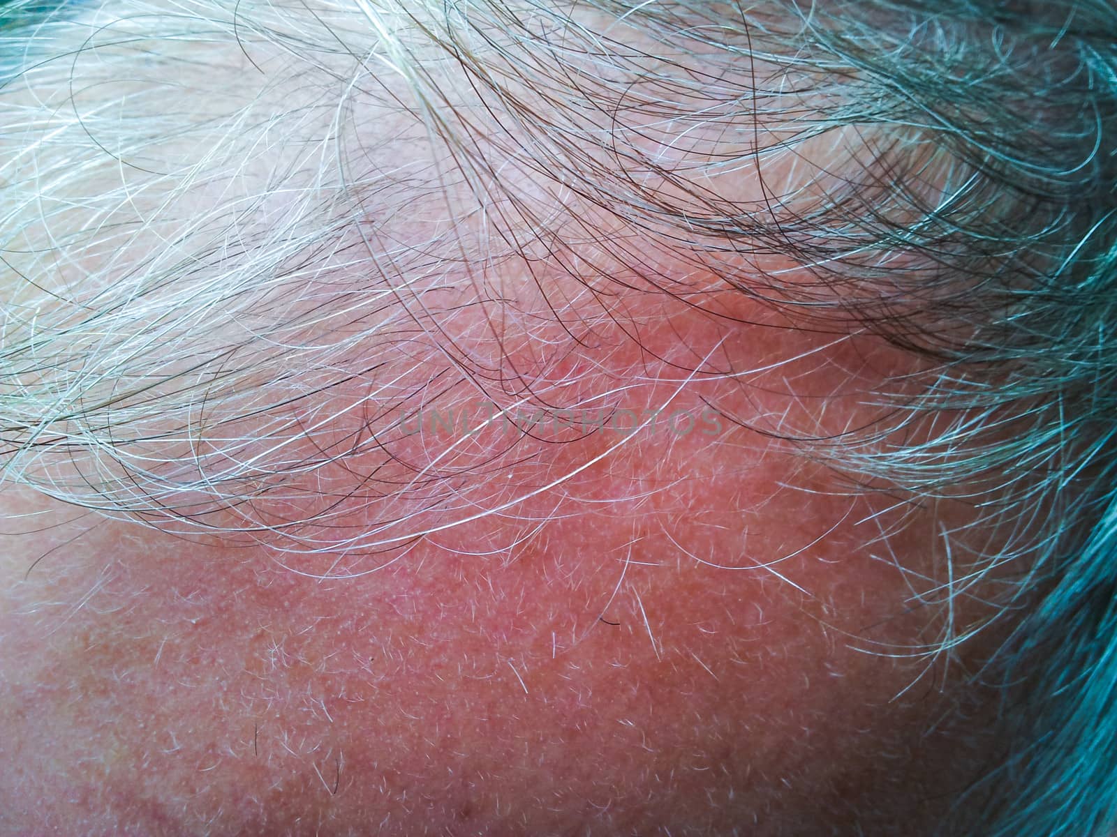 Grey hair, balding by Arvebettum