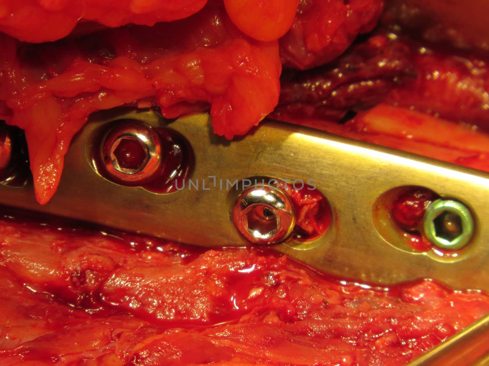 A titanium plate affixed in a broken thigh during a surgery in hospital.                               