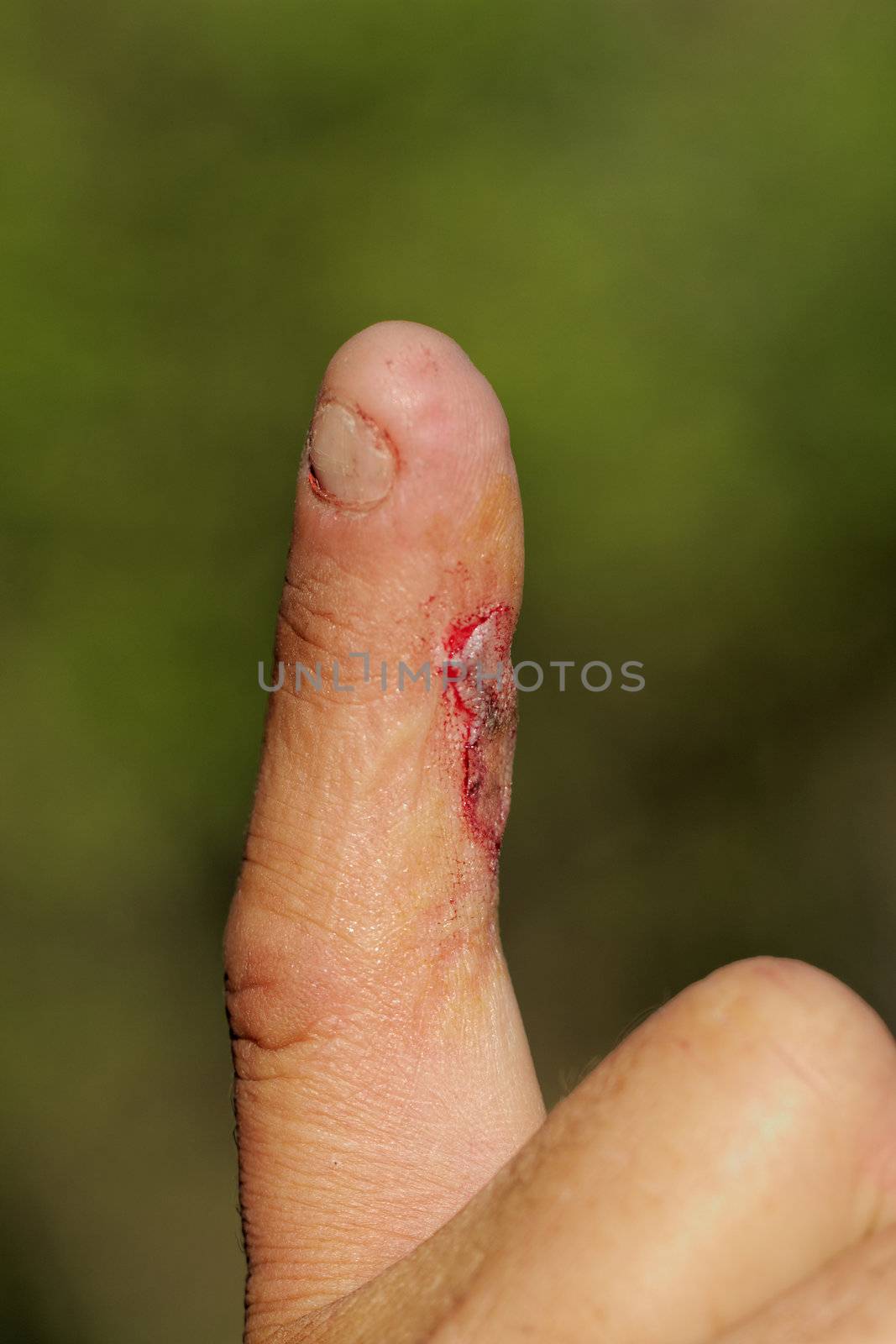 Flesh wound with blood on male finger