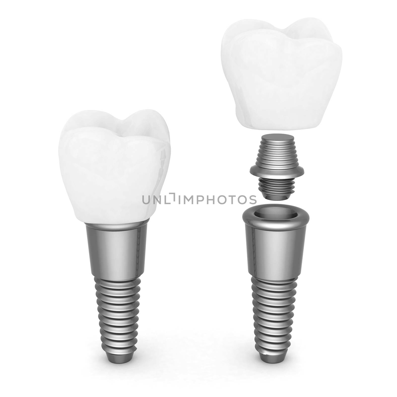 Dental implants by mrgarry
