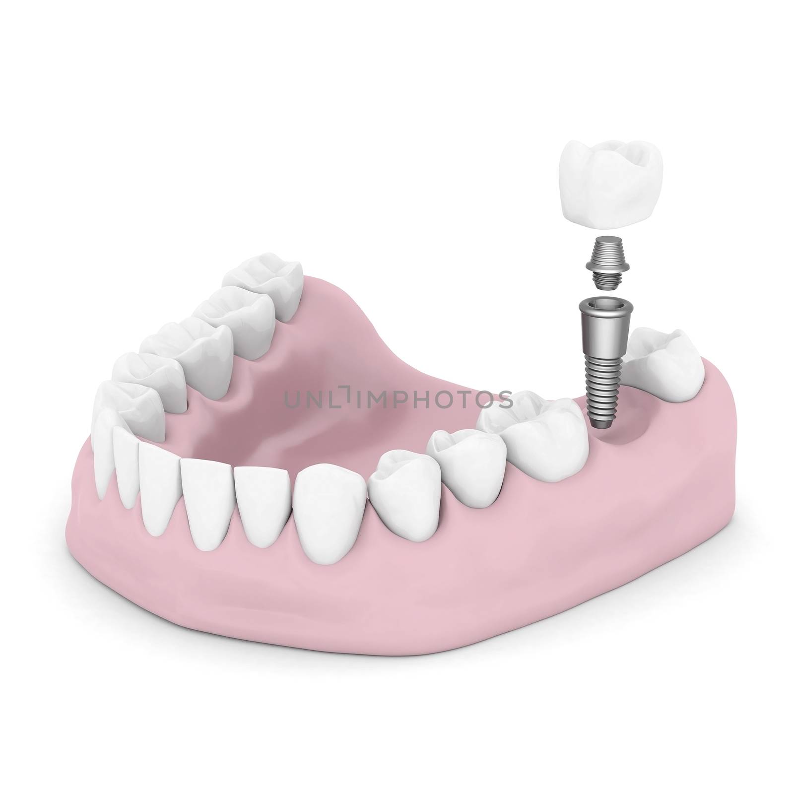 Dental implants by mrgarry
