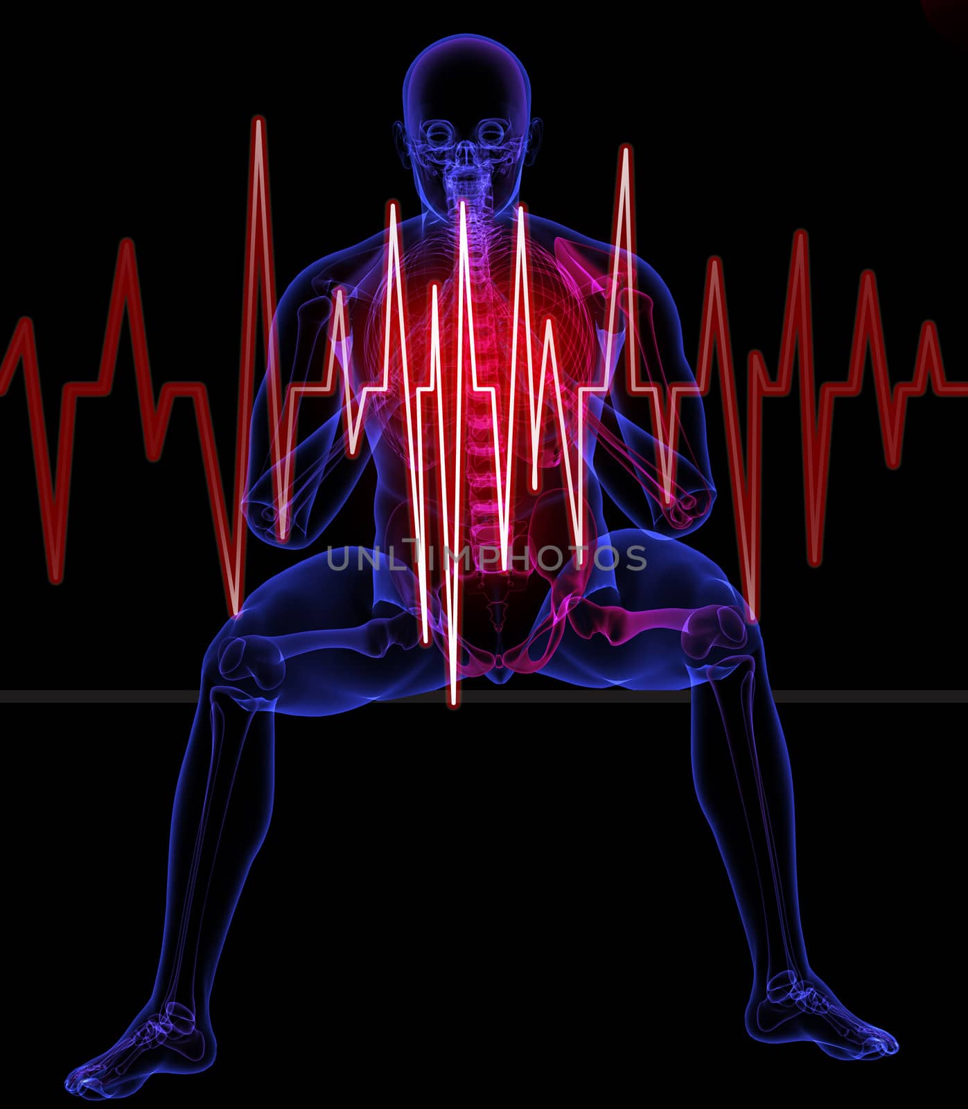 Heart attack concept by vitanovski