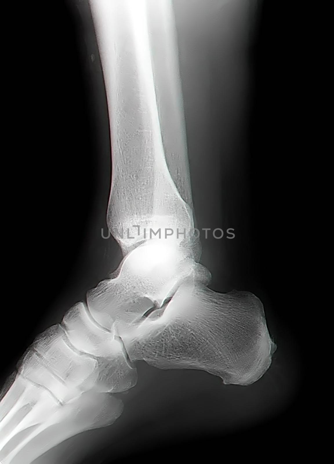 human leg bone X-rays