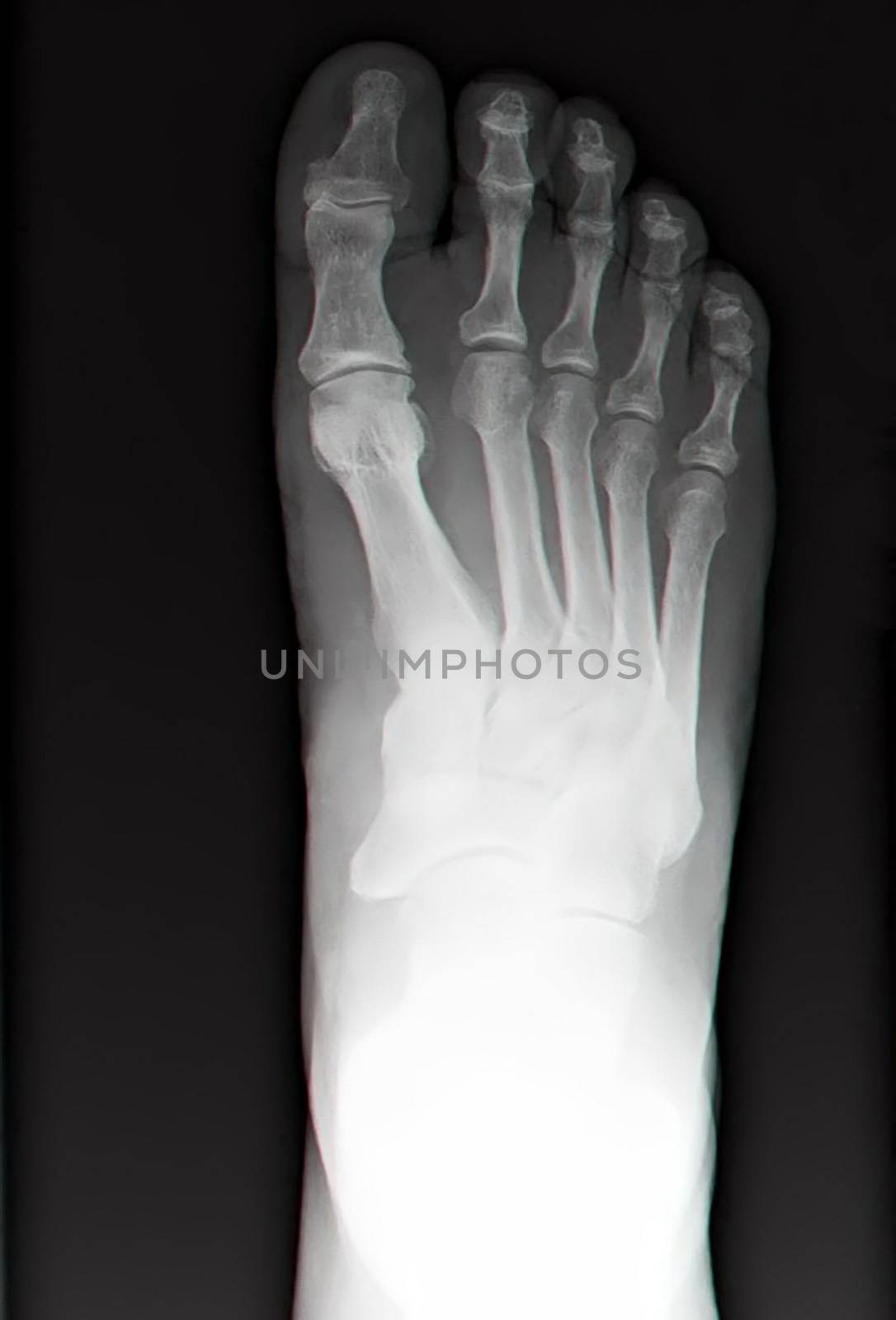 human leg bone X-rays