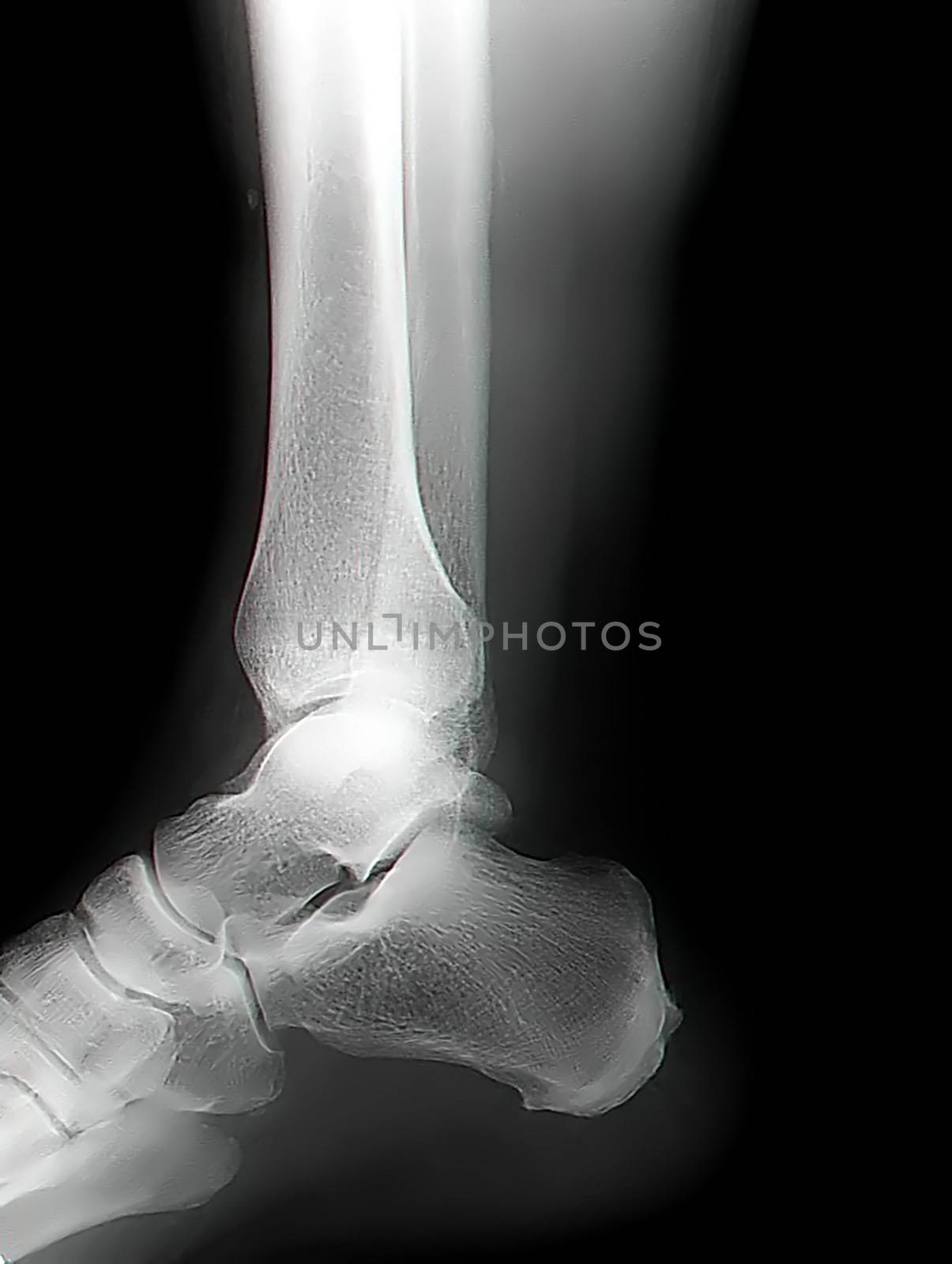 human leg bone X-rays