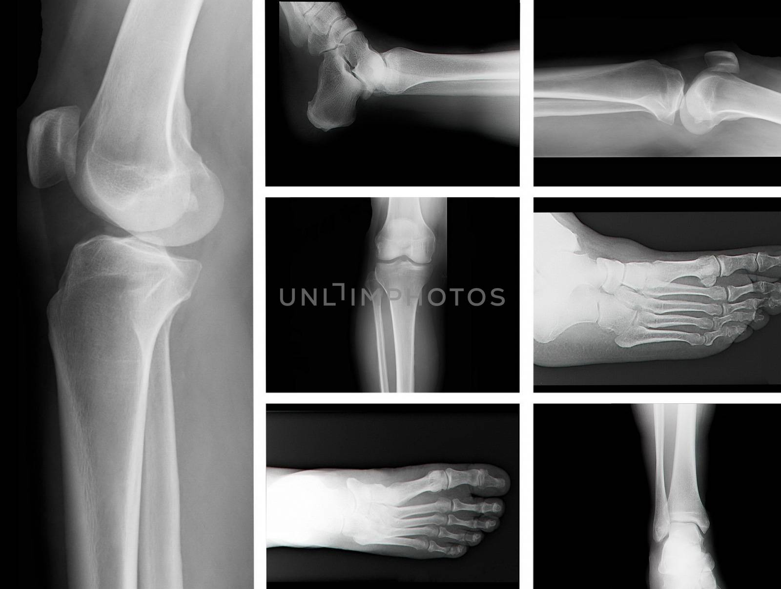 human leg bone X-rays