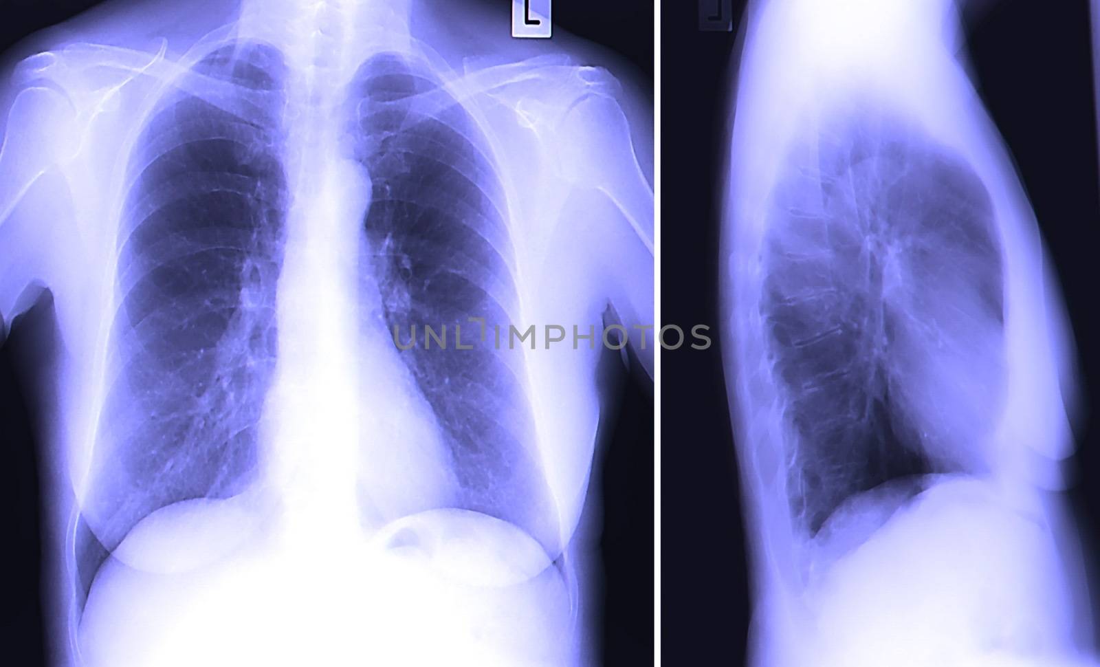 A chest x-ray image for a medical diagnosis